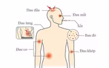 [ẢNH] Những loại bệnh dịch phổ biến do thời tiết ở Việt Nam